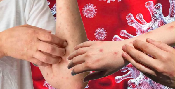 जयपुर में एम पॉक्स की दस्तक विदेश से लौटे मरीज में मिले लक्षण - rajasthan news in hindi
